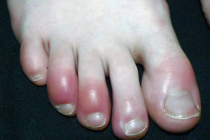 Read more about the article Covid Toes